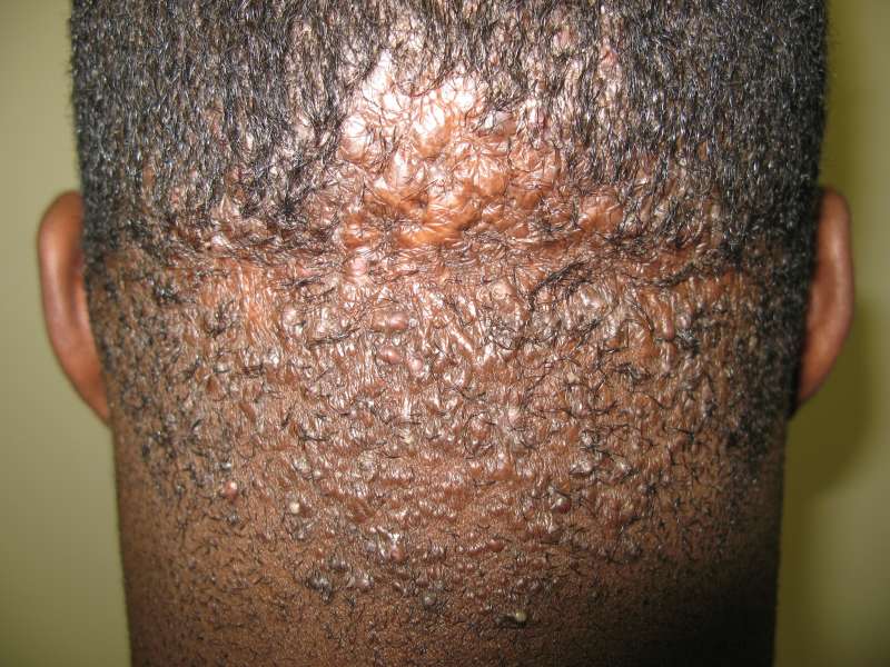 Folliculitis in Adults: Condition, Treatments, and ...