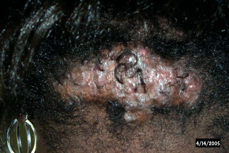 Scalp Disorders on Female With Advanced Akn