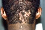 Keloids and Hair Loss due to chronic AKN