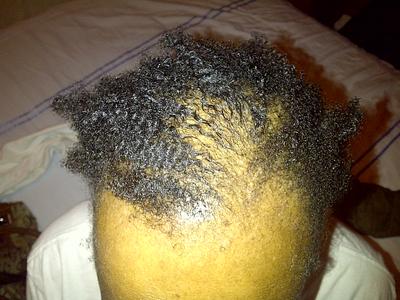 Is this cicatricial alopecia? 