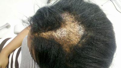 Steroid injections for scarring alopecia