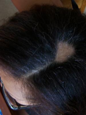 Stress or Thyroid Problem makes your hair fall out?