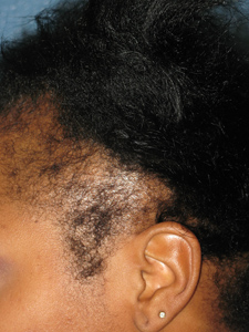 Traction Alopecia Patient Houston Texas