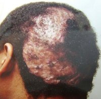 Scalp Diseases - shutterstock.com