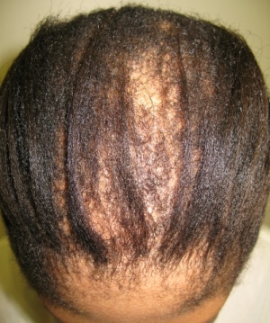 early cicatricial alopecia