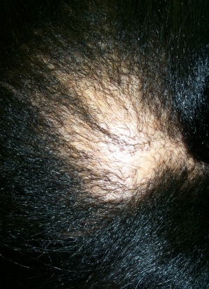 Progressive Cicatricial Alopecia
