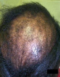 Advanced Cicatricial Alopecia