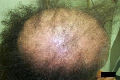 Advanced Cicatricial Alopecia