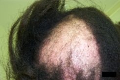 Advanced Cicatricial Alopecia